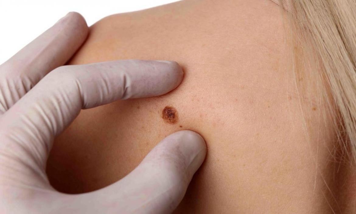 Lanzan campaña de control dermatológico para prevenir cáncer de piel